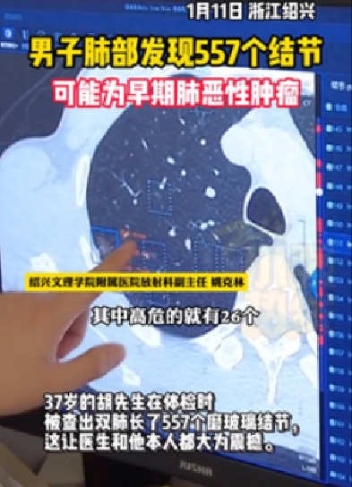 37岁男子肺部发现557个结节：医生和他本人都大为震撼 ！